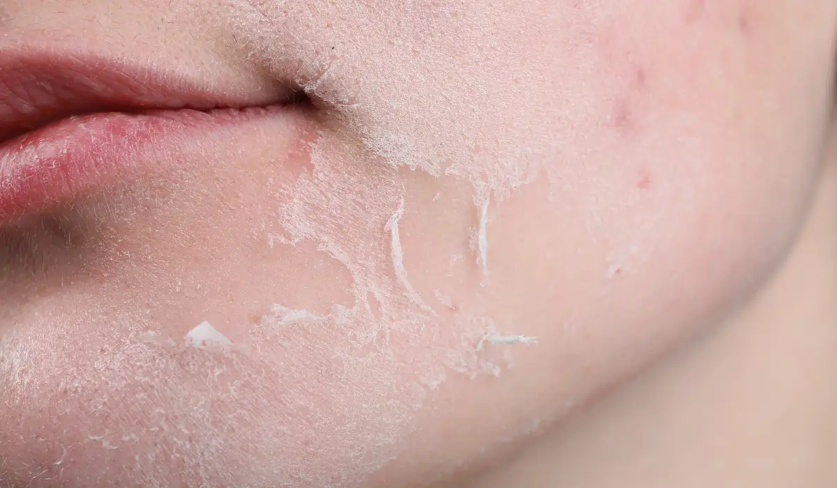 dry-skin-sunscreen | shikshim