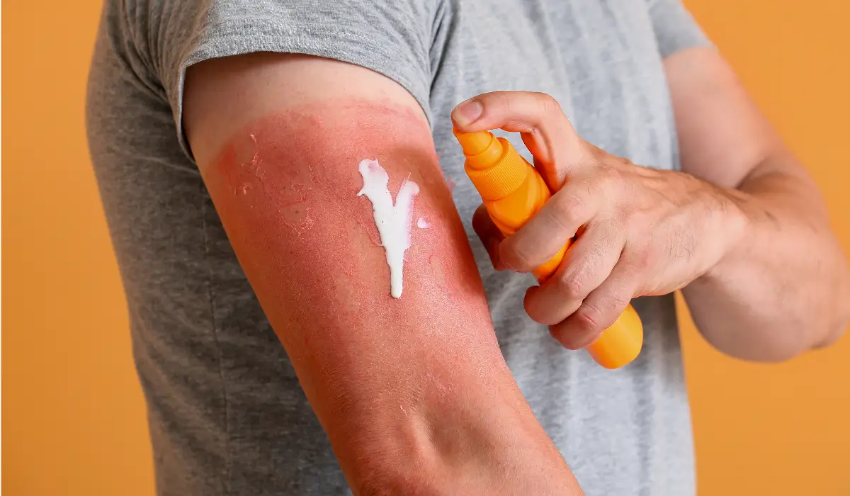 مضرات عدم استفاده از ضد آفتاب